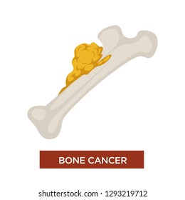 Marrow Disease Bone Cancer Malignant Tumor And Oncology Isolated Vector Icon Treatment Or Cure Chemotherapy And Surgery Sarcoma Or Carcinoma Health Damage Abnormal Physical Condition Myeloma.