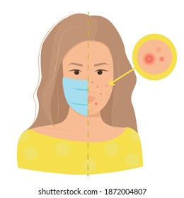 Maskne concept. Acne caused wearing face mask due to coronovirus pandemic. Flat female character portrait struggling with pimples. Acne closeup. 