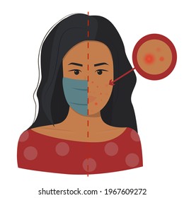 Maskne Concept. Acne Caused Wearing Face Mask Due To Coronavirus Pandemic. Flat Brunette Indian Asian Nationality Female Character Portrait Struggling With Pimples. Acne Closeup Vector Illustration