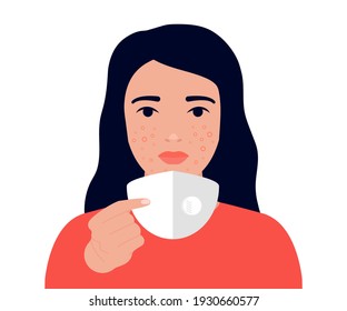 Maskne On Face Woman Concept. Result Wearing Face Protective Mask - Acne. Problem Pimple, Inflamation Skin, Blemish, Allergy. Vector Flat Illustration