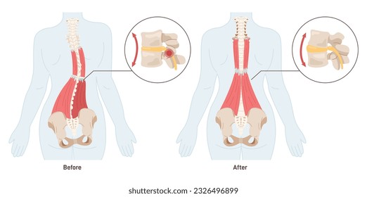 Massage effect. Back pain treatment and muscles relaxation. Spasmed muscle of a vertebral column and pinching nerve physical rehabilitation. Flat vector illustration