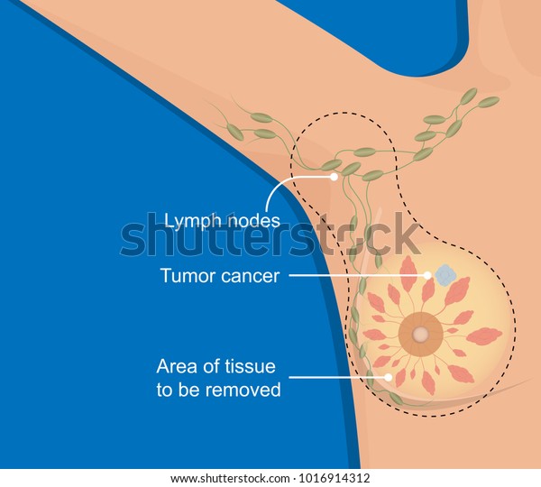 Mastectomy Breast Cancer Lymph Node Dissection Stock Vector Royalty Free 1016914312