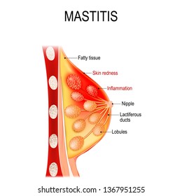 Mastitis Images Stock Photos Vectors Shutterstock