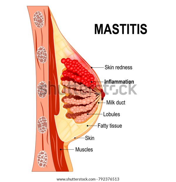 Resultado de imagen para mama mastitis anatomia"