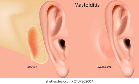 Mastoiditis. Inflamación del revestimiento mucosal del sistema mastoid antrum y mastoid air cell system dentro del proceso mastoid. Ilustración médica