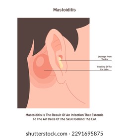 Mastoiditis. Inflammatory disease of the ear. Bacterial mastoid bone behind the ear infection. Flat vector illustration