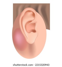 Mastoiditis. Inflammatory disease of the ear. Medical poster vector illustration