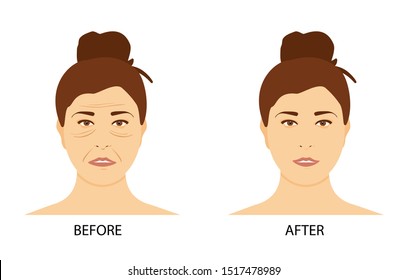 Mature woman face before and after cosmetic procedure neurotoxin injections. Plastic surgery concept. Woman face wrinkles after treatment