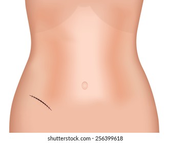 McBurney's Incision Scar