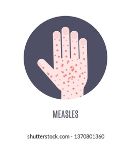 Measles Infection Awareness Medical Poster. Hand Covered With Rash Red Spots. Virus Symptom Symbol. Vector Illustration.