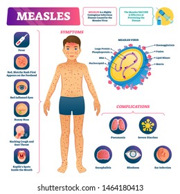 Measles vector illustration. Labeled medical virus disease medical scheme. Anatomical symptoms, prevention and complications list. Educational infographic visualization. Contagious infection illness.