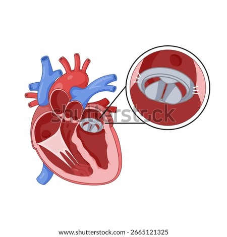 Mechanical Mitral Valve Heart Cross-section Illustration