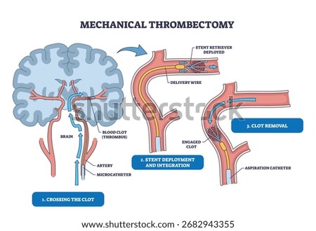 Mechanical thrombectomy diagram shows brain, artery, and stent illustrating clot crossing, stent deployment, and clot removal steps. Outline diagram