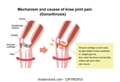 Mechanism and causes of knee joint pain (gonarthrosis / osteoarthritis / arthrosis of knee ) . flat illustration.