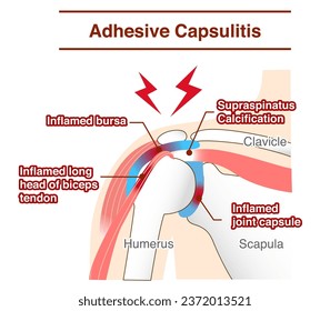 Mechanism and causes of periarthritis and frozen shoulder