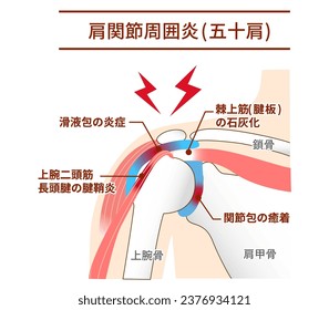 Mechanism and causes of periarthritis and frozen shoulder :Translate. supraspinatus muscle
supraspinatus calcification ,Calcific, Tendinopathy of the Shoulder,Inflamed bursa