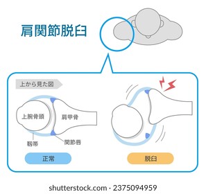 Mechanism and causes of shoulder joint dislocation from above ;Translate Shoulder dislocation, normal, ligament