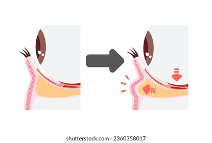 Mechanism of dark circles caused by aging. Vector illustration of cross section ( no text )