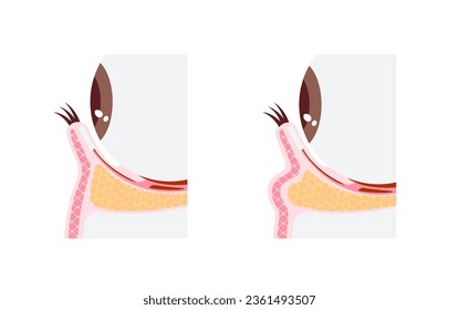 Mechanism of dark circles caused by aging. Vector illustration of cross section ( no text )