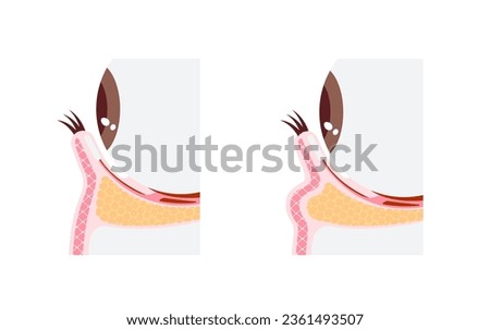 Mechanism of dark circles caused by aging. Vector illustration of cross section ( no text )