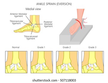 Mechanism of formation of an ankle sprain and Grades of an ankle sprain (Eversion) illustration with external and skeletal (medial) view