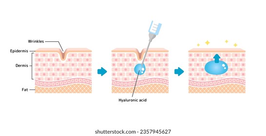 Mechanism illustration of hyaluronic acid injection (cross-sectional view of the skin)