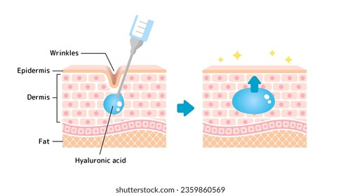 Mechanism illustration of hyaluronic acid injection (cross-sectional view of the skin)