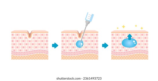 Mechanism illustration of hyaluronic acid injection (cross-sectional view of the skin)