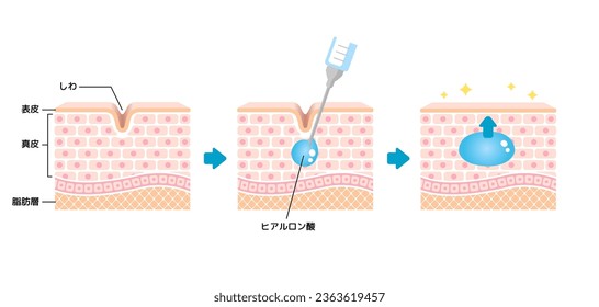 Mecanismo de ilustración de la inyección de ácido hialurónico (visión transversal de la piel). Traducción: Arrugas, ácido hialurónico, epidermis, dermis, grasa