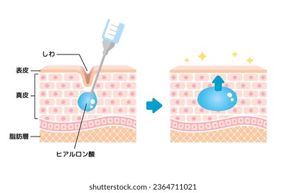 Mechanism illustration of hyaluronic acid injection (cross-sectional view of the skin). Translation: Wrinkles, Hyaluronic acid, Epidermis, Dermis, Fat