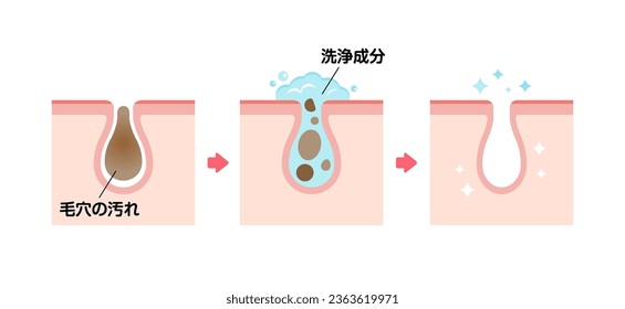 Mecanismo de ilustración del cuidado de la piel, limpieza de la piel (sección transversal de la piel). Traducción: Suciedad en poros, lavado