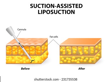 Mechanism of liposuction. Suction-assisted liposuction. hollow tube (cannula) which is inserted through a small incision in the skin  in order to fat suctioned out of the body