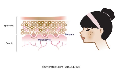 The mechanism of melasma skin vector on white background. Infographic illustration of woman face and skin layer structure. Skin care and beauty concept.