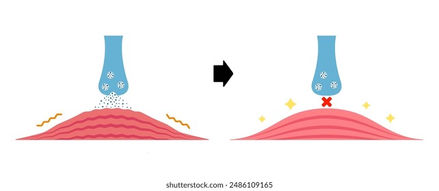 Mechanism of muscle relaxation by Botox. Vector illustration.