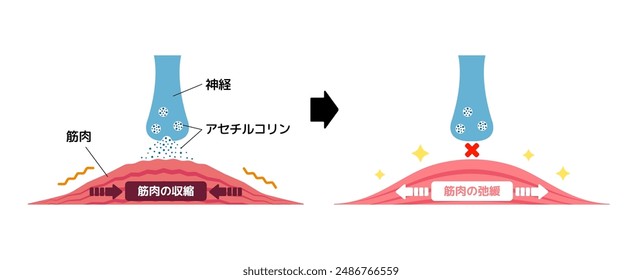 Mechanism of muscle relaxation by Botox. Vector illustration. Translation: Nerve, Muscle, Acetylcholine, Contraction muscle, Relax muscle.