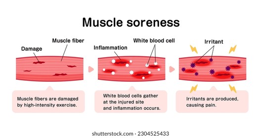 Mecanismo de la ilustración del vector de dolor muscular