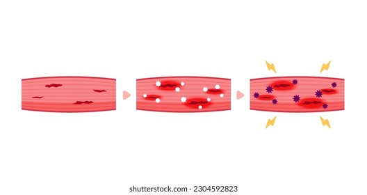 Mechanism of muscle soreness vector illustration