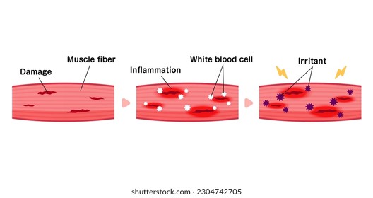 Mechanism of muscle soreness vector illustration