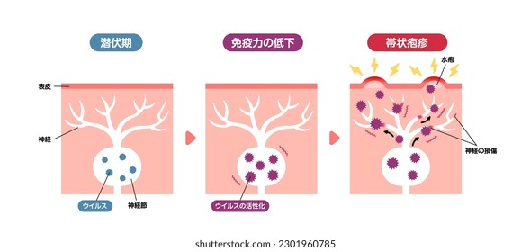 Mecanismo de hingles ( herpes zoster ) ilustración vectorial. Traducción: Período de incubación, Sistema inmunitario débil, Singles, Blister, Epidermis, Fibra Nerviosa, Virus, Ganglion, Daño Nervioso.