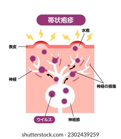 Mechanism of shingles ( herpes zoster ) vector illustration. Translation: Shingles, Blister, Epidermis, Nerve fiber, Virus, Ganglion, Nerve damage.