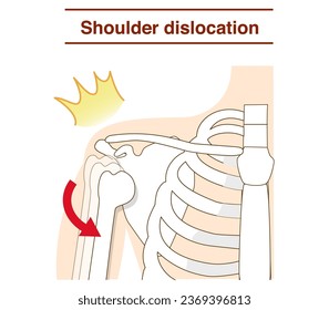 Mechanism of shoulder joint dislocation - Shutterstock ID 2369396813