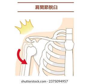 Mechanism of shoulder joint dislocation ;Translate Shoulder dislocation
