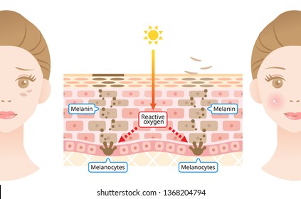 mechanism of skin cell turnover and facial dark spots. Melanin and melanocytes in human skin layer with woman face. beauty and skin care concept