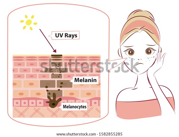 Mechanism of skin cell turnover and facial\
dark spots. Melanin and melanocytes in human skin layer with woman\
face. beauty cartoon illustration.\

