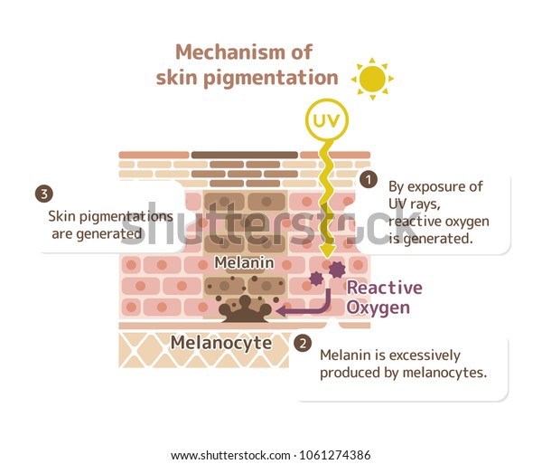 皮膚の色素沈着のメカニズム 皮膚の斑点イラスト 説明付き のベクター画像素材 ロイヤリティフリー