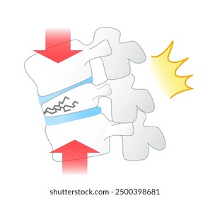 Mechanism of spinal compression fracture due to osteoporosis seen from the side