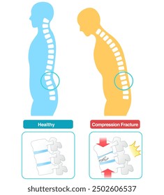 Mechanism of spinal compression fracture due to osteoporosis seen from the side