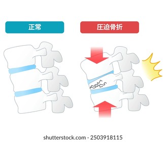 Mechanism of spinal compression fracture due to osteoporosis seen from the side [Translate]spinal compression fracture, normal bone