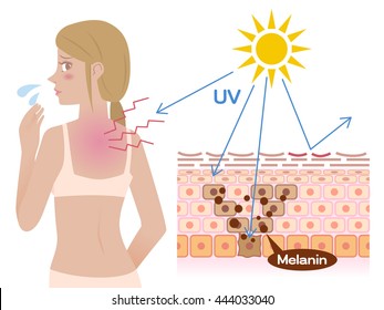 mechanism of sunburn, young female with a bad sunburn on her back