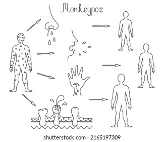 The Mechanism Of Transmission Of Monkeypox. Diagram Of Human-to-human Transmission Of The Smallpox Virus. Sketch. Transmission Through Body Fluids, Skin Injury, Discharge From Pustules. Vector 